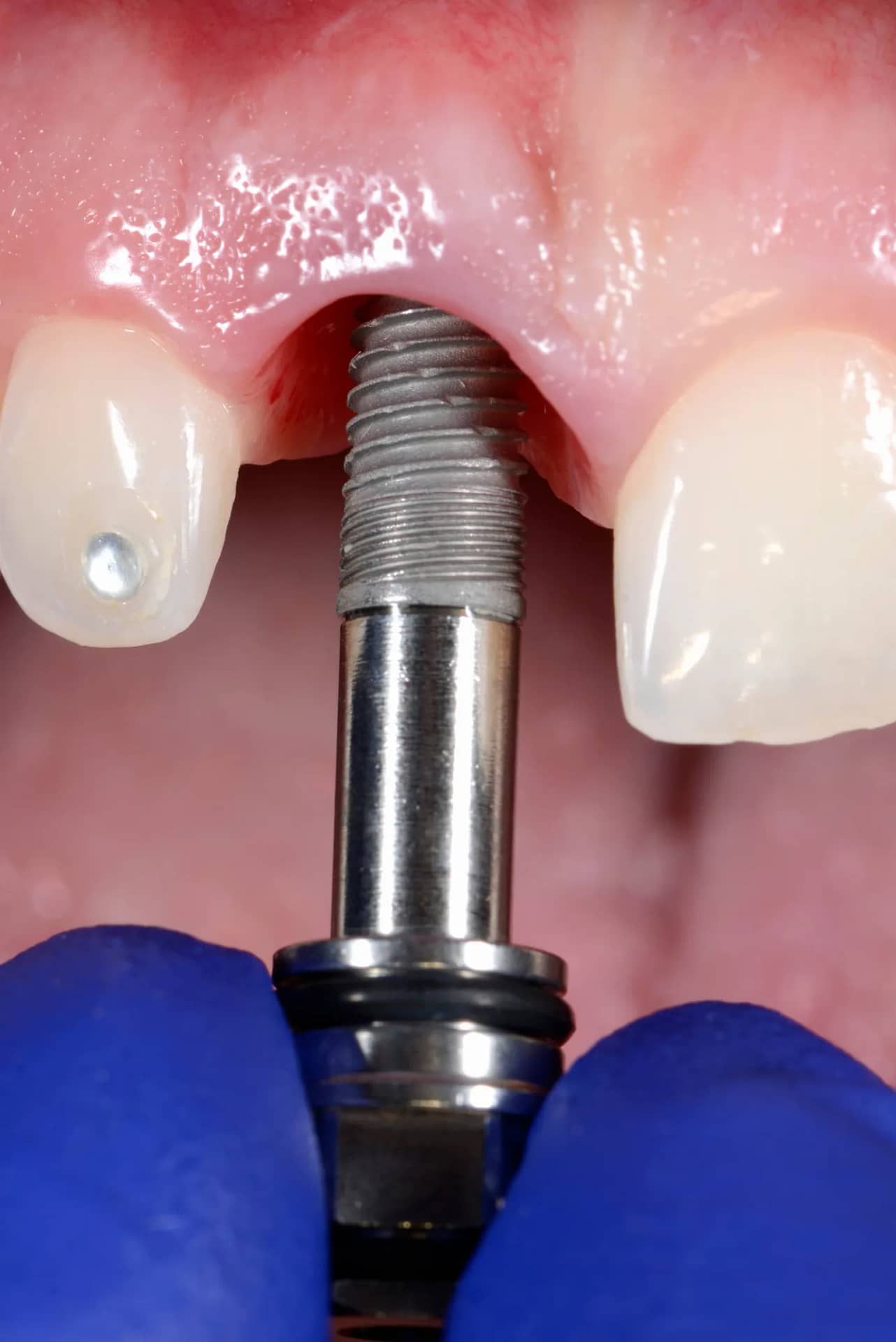 Dental Implants in Kakkanad